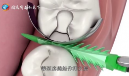 拔牙视频全过程